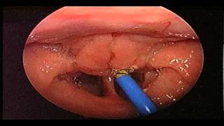 Adenoidectomy Surgery  Removal Of Adenoids  ENT Consultant London  ENT Surgeon London [upl. by Zeba]