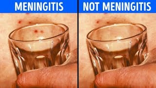 Use This Glass testing Method And Find Out if You Have Meningitis [upl. by Olympium]