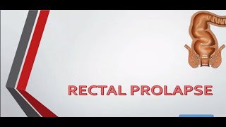 Rectal Prolapse causes and treatment – General Surgery Lecture [upl. by Yduj43]