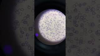 Severe microcytic hypochromic anemia patients slide microscopey [upl. by Gnouc]