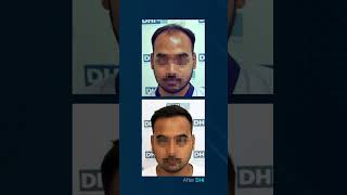 DHI Hair Transplant  Another week of excellent results and happy clients [upl. by Gosser536]