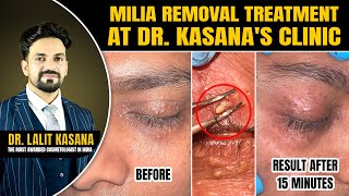 Milia Removal Treatment at DrKasanas Clinic  MILIA Removal Extraction  Before and after [upl. by Savina]