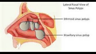 What Are Nasal Polyps [upl. by Aihsercal551]