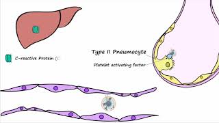 Bacterial Pneumonia  Pathogenesis [upl. by Ainsworth]