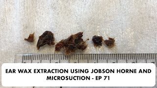 EAR WAX EXTRACTION USING JOBSON HORNE AND MICROSUCTION  EP 71 [upl. by Lela131]