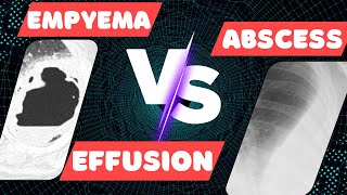 Empyema vs Lung Abscess vs Pleural Effusion on IMAGING [upl. by Esojnauj282]