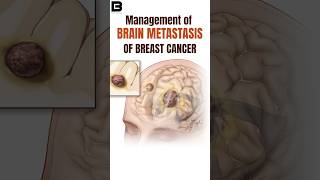 Brain Metastasis Of Breast Cancer How is It Treated BrainMetastasisCancerTreatmentOncologyCare [upl. by Doownelg]