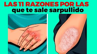 11 razones por las que te sale sarpullido o ronchas en el cuerpo [upl. by Rosenberger]