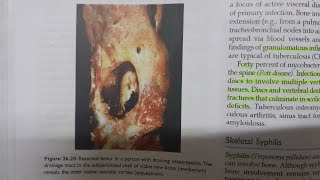 Osteomyelitis  SPECIAL PATHOLOGY [upl. by Werna]