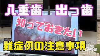 八重歯➕出っ歯の難症例の注意点 白いワイヤー矯正 マウスピース矯正の不適応症例 大宮 鈴木歯科医院 矯正歯科 [upl. by Idnerb]