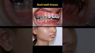 Buck teeth braces process braces niengrang orthodontist dental [upl. by Olethea]