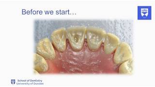 Endodontic treatment of the single rooted tooth Part 2 Access cavity preparation [upl. by Eno]