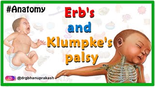 Erbs palsy and klumpkes palsy USMLE Animation  Etiology Clinical features Diagnosis Treatment [upl. by Wiener]