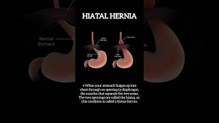 Hiatus hernia I Treatment for hiatus hernia in Delhi [upl. by Suhsoj]