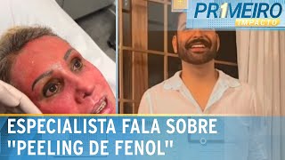 Dermatologista explica como funciona o “peeling de fenol”  Primeiro Impacto 040624 [upl. by Jc]