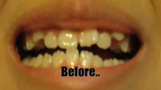 Braces 2 MONTHS watch my updated FULL braces time lapse [upl. by Lugo]