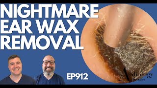 NIGHTMARE EAR WAX REMOVAL  EP912 [upl. by Binni]