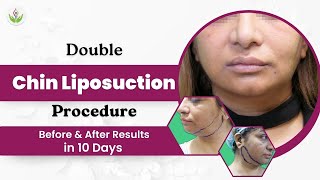 Double Chin Liposuction Procedure Before amp After Results in 10 Days  Care Well Medical Centre [upl. by Ativad111]