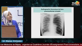 quotLe pneumothorax au bloc des urgences médicalesquot par Manaa Ardjouna MCB CHU Sétif [upl. by Divod917]