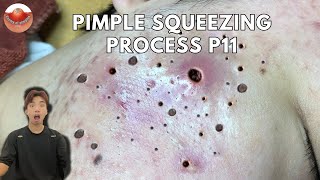 The MOST TERRIFYING Acne Squeezing Videos Youve Ever Seen 11 [upl. by Ha]