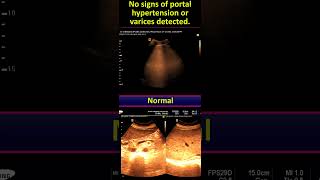 Wilsons disease  CLD  Splenomegaly [upl. by Abner]