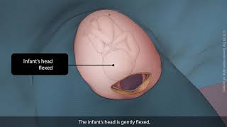 Primary vertex caesarean section Csection  TVASurg [upl. by Amhsirak]