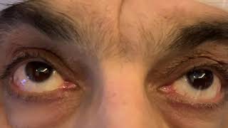 Downgaze palsy due to brain stem lesions [upl. by Ayikur714]