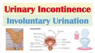 Urinary Incontinence Stress Urge Overflow amp Functional  Causes Symptoms Diagnosis Treatment [upl. by Cranford]