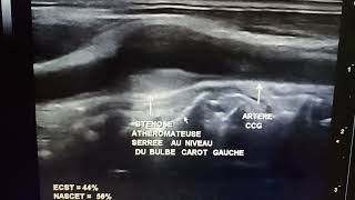 Échodoppler des TSA Sténose athéromateuse serrée [upl. by Eugirne855]