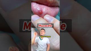 Mucocele [upl. by Dirgis]