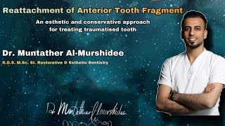 Reattachment of anterior tooth fragment  DrMuntather Almurshidee [upl. by Atsillak]