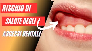 Ascesso dentale cause sintomi e trattamenti essenziali [upl. by Bluhm]