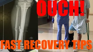 How to Recover Quickly From Broken Leg Fractured Tibia  Fibula ORIF Surgery [upl. by Vaughan]