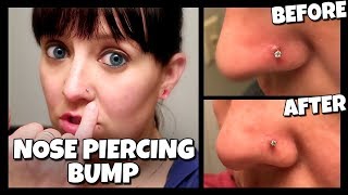 How To Get Rid Of A Nose Piercing Bump FAST  Keloid 📍 How To With Kristin [upl. by Tabby]