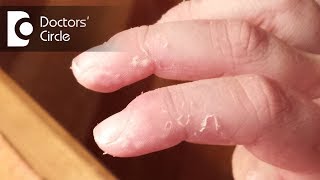 What causes skin peeling of fingers in a child  Dr Varsha Saxena [upl. by Elliot]