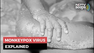 Monkeypox 5 Things You Should Know About This Rare Virus [upl. by Merta]