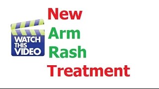 Erythematous rash Underarm rash Arm rash [upl. by Naid]