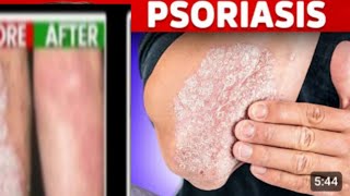 ECZEMA PSORIASIS KA TREATMENT [upl. by Bonaparte]