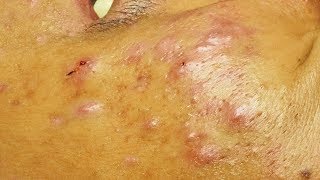 Enlever les points noirs les microkystes et un acné kystique a cystic acne [upl. by Filberte]