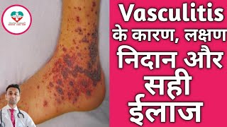 Vasculitis क्या होता है क्यू होता है इसका ईलाज कैसे होता है Vasculitis Hindi [upl. by Arhna]