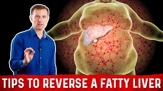 4 Critical Tips to Reverse a Fatty Liver – Dr Berg [upl. by Winter]