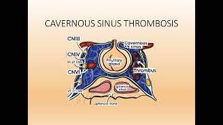 Cavernous Sinus Thrombosis PPT Slide Presentation [upl. by Ahtikal]