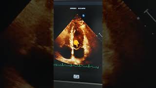 Prolapso Valvular mitral leve [upl. by Athena]