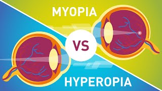 Difference between Myopia Near Sightedness amp Hyperopia FarSightedness [upl. by Douglass]