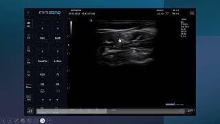 Ultrasound guided Interscalene brachial plexus nerve block [upl. by Anivle]