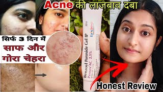 Benzoyl Peroxide Gel Honest Review  Benzoyl peroxide gel 25 Pernex  Benzoyl peroxide for acne [upl. by Jacquenetta]