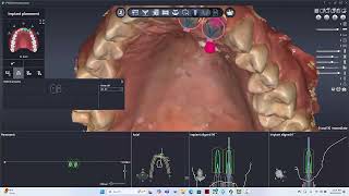 Pre Printed Immediate Temporary and Surgical Guide case in Pylon Part 1 [upl. by Mullins]