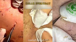 ASMR Blackhead and Acne Extraction  TikToks  Relax [upl. by Ettelocin736]