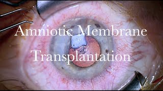 Amniotic Membrane Inlay and Onlay Transplantation for a corneal ulcer with Descemetocele [upl. by Mandeville988]