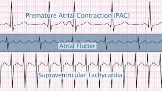 quotSupraventricular Arrhythmiasquot by Christine LaGrasta MS RN CPNP PCAC for OPENPediatrics [upl. by Fishbein527]